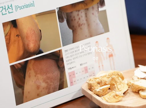 생기한의원 건선 관련, 피부 병변 형태와 부위별 특징 안내